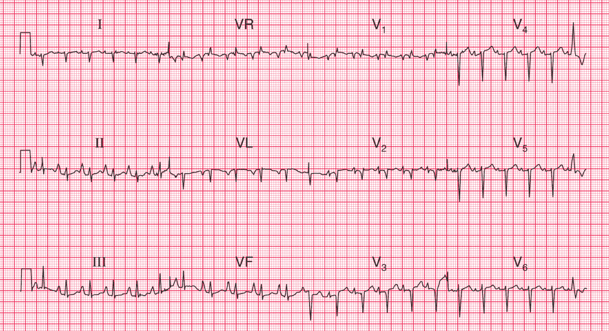Sinus Tachycardia with Right Atrial and Right Ventricular Hypertrophy – Suggesting Chronic Lung Disease