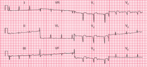 Read more about the article ECG Case 76: Old anterior MI with a Left Ventricular Aneurysm
