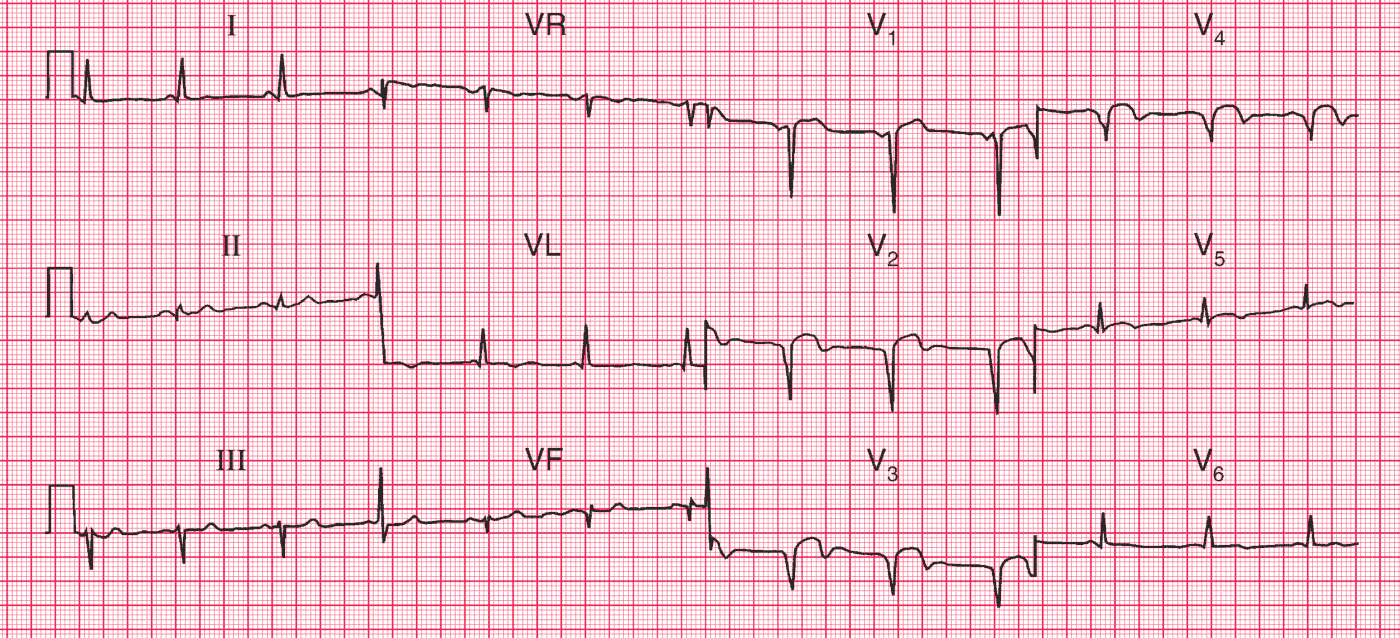 Read more about the article ECG Case 76