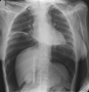 Read more about the article Patient with Progressively Worsening Abdominal Distention and Pain