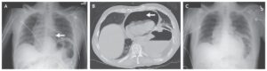 Read more about the article Pneumopericardium Associated with a Peptic Ulcer