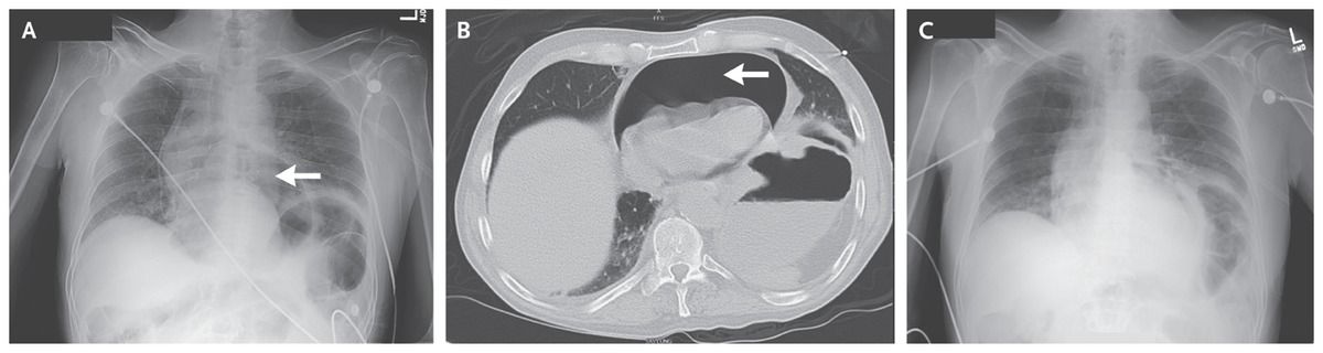 Pneumopericardium Associated with a Peptic Ulcer