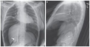 Read more about the article Pneumoperitoneum due to Bowel Perforation
