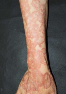 Read more about the article Asymptomatic, Widespread, Erythematous-to-Violaceous Papules and Plaques