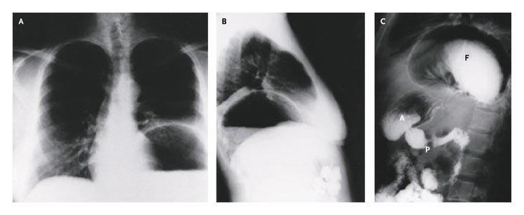 Chest X-ray of Paraesophageal Hernia