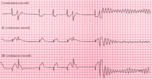 Read more about the article ECG Case 77: Probable Inferior MI and Ventricular Fibrillation