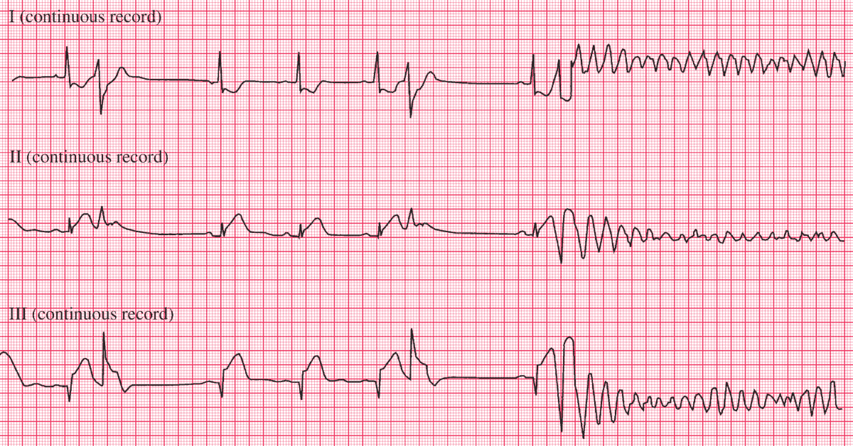 Probable inferior myocardial infarction; R on T ventricular extrasystole, causing ventricular fibrillation