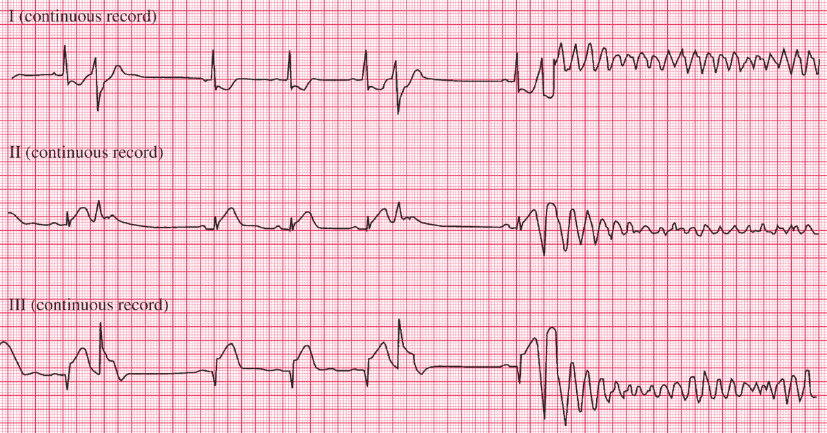 ECG Case 243 - Manual of Medicine