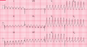 Read more about the article ECG Case 78: Ventricular tachycardia in a 60-year-old man