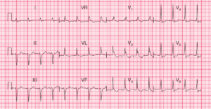 Read more about the article ECG Case 79: Left Anterior Hemiblock and RBBB – Bifascicular Block