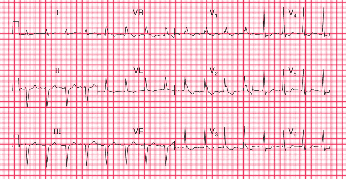 Read more about the article ECG Case 79