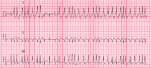 Read more about the article ECG Case 80
