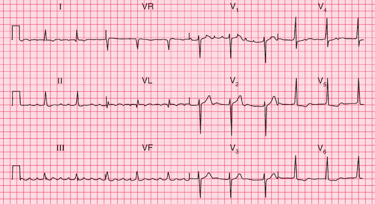 Read more about the article ECG Case 81