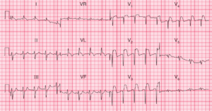 Read more about the article ECG Case 82: Acute Antero-Lateral STEMI and Left Anterior Fascicular Block (LAFB)