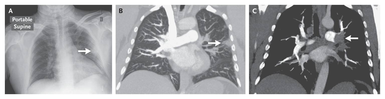 Hampton's Hump indicating pulmonary infarction distal to a pulmonary embolism