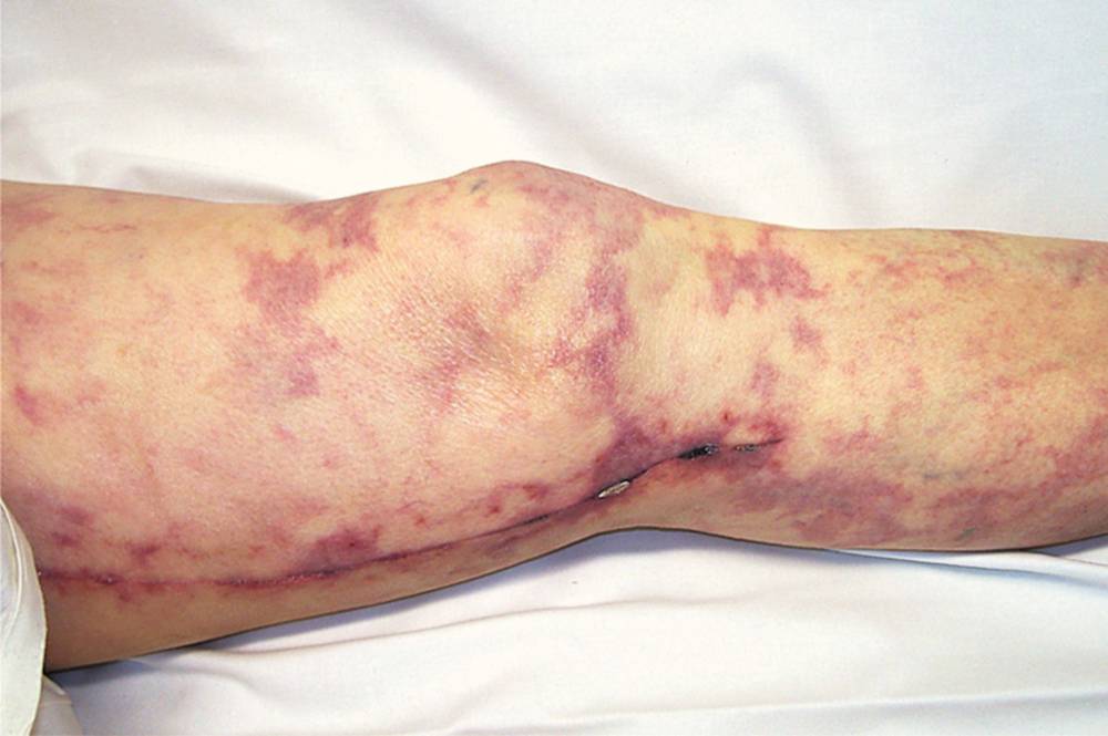 Read more about the article Livedo Reticularis and Cyanosis of the Toes After CABG