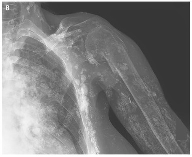 Radiograph of the left shoulder showed extensive soft-tissue calcification
