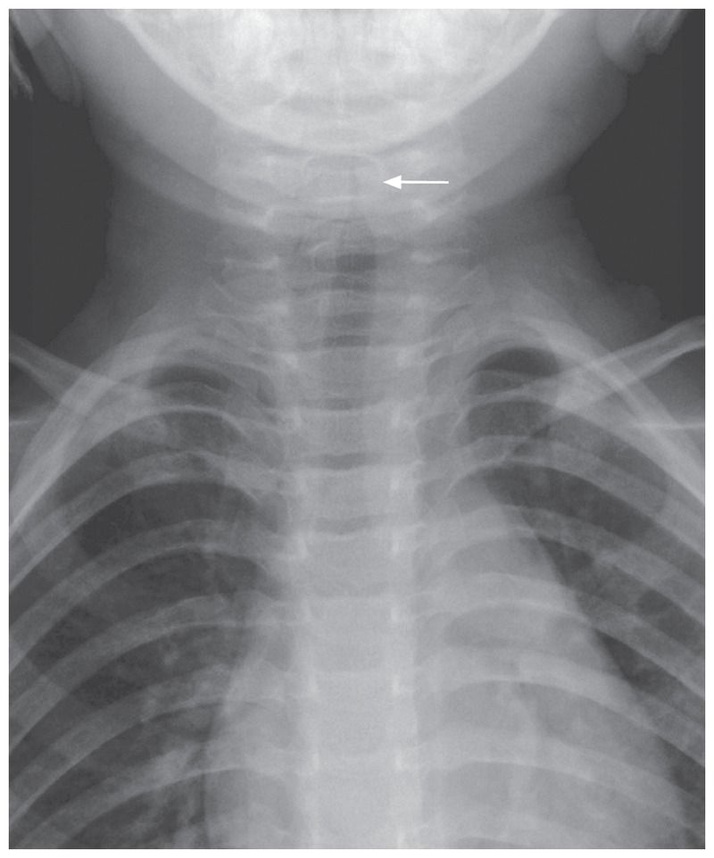 Steeple sign on Chest X-ray (subglottic narrowing of the trachea, suggestive of laryngotracheobronchitis or croup)