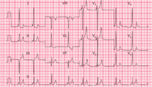 Read more about the article ECG Case 80: Atrial Fibrillation and WPW Syndrome