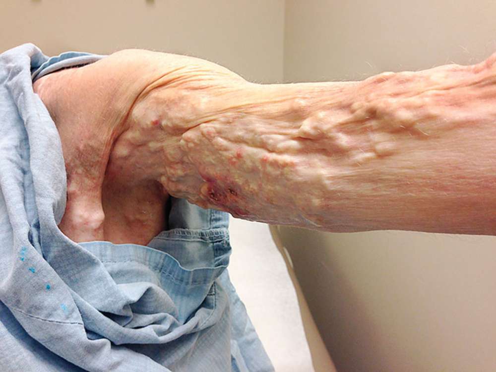 Read more about the article Woman with Dermatomyositis and Subcutaneous Nodules on the Arms and Legs
