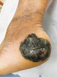 Read more about the article 2-year history of a nonhealing ulceration on the left heel