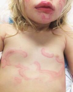 Read more about the article 3-year-old Girl with Pruritic Blanching Rash
