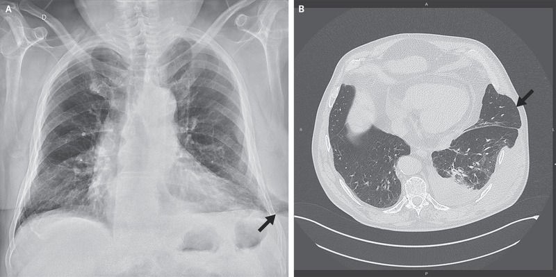 Chest X-Ray and CT showing Lung Herniation Caused by Coughing