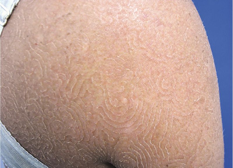 Read more about the article Concentric, Scaly Rash on Shoulders, Trunk, Arms, and Legs