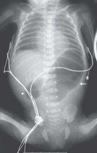 Read more about the article Congenital Duodenal Obstruction and Double-Bubble Sign on X-Ray