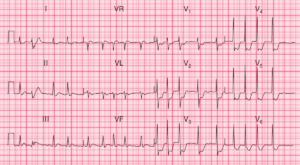 Read more about the article ECG Case 85: Posterior MI and Atrial Fibrillation