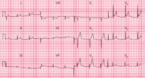 Read more about the article ECG Case 86: Benign Early Repolarization