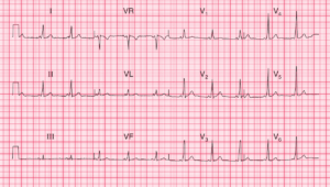 Read more about the article ECG Case 87: WPW syndrome type A