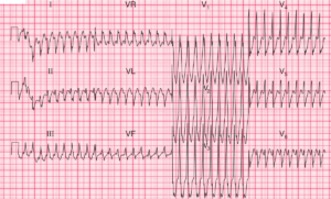 Read more about the article ECG Case 88: Antidromic AVRT with WPW