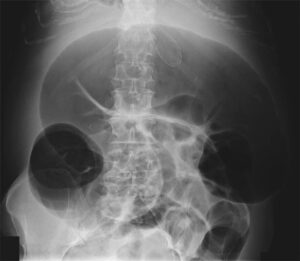 Read more about the article Acute Colonic Pseudo-Obstruction (Ogilvie’s syndrome)