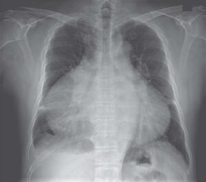 Read more about the article Chest X-ray of a Patient With New Peripheral Edema