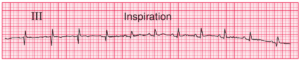 Read more about the article ECG Case 95: Normal ECG with Q waves and inverted T waves in lead III