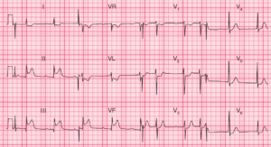 Read more about the article ECG Case 89: Acute infero-posterior STEMI with first degree AV block