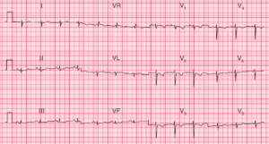 Read more about the article ECG Case 90: Right Ventricular Strain due to Pulmonary Embolism