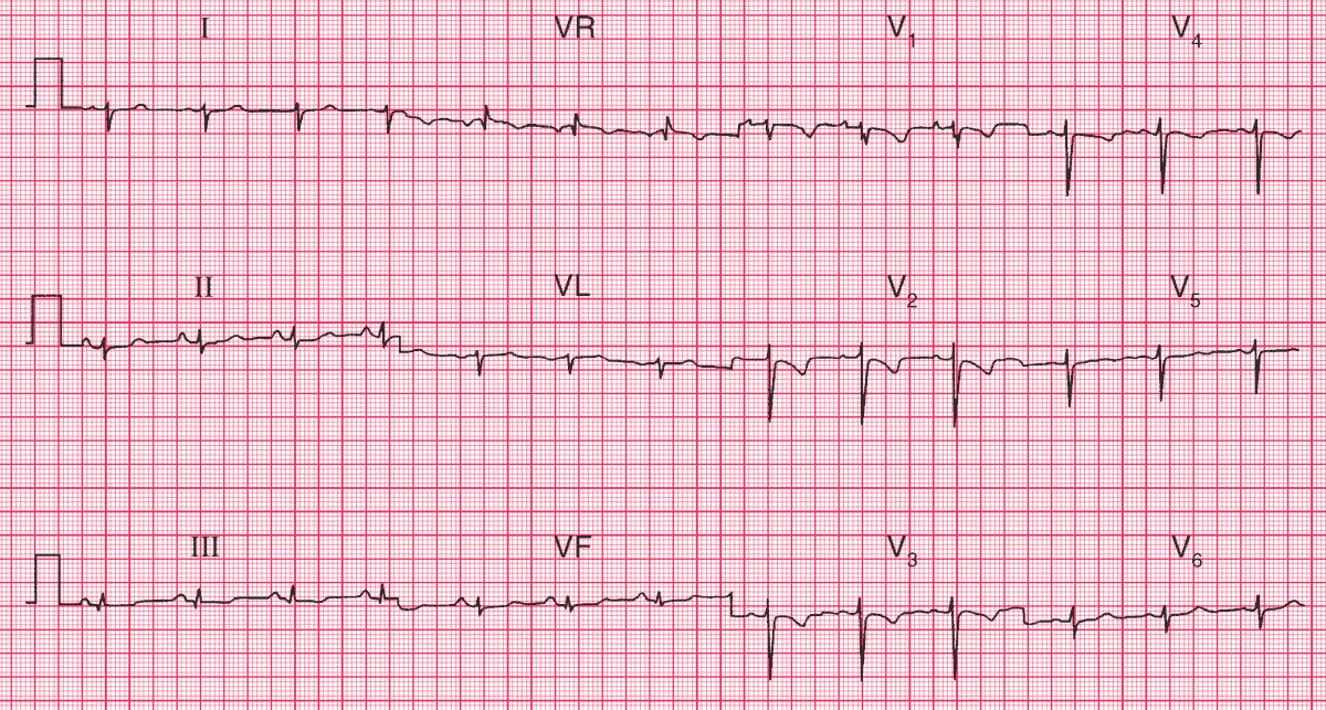Right Ventricular Strain due to Pulmonary Embolism