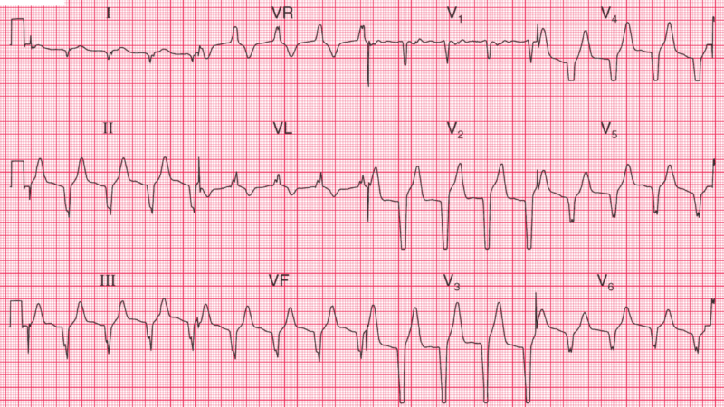 ECG Case 79: Left Anterior Hemiblock and RBBB – Bifascicular Block ...