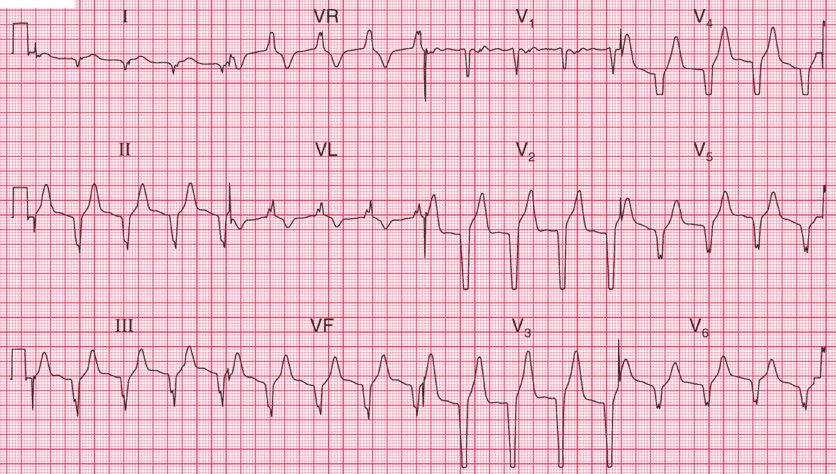 Read more about the article ECG Case 91