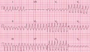 Read more about the article ECG Case 92: Ventricular tachycardia (VT)
