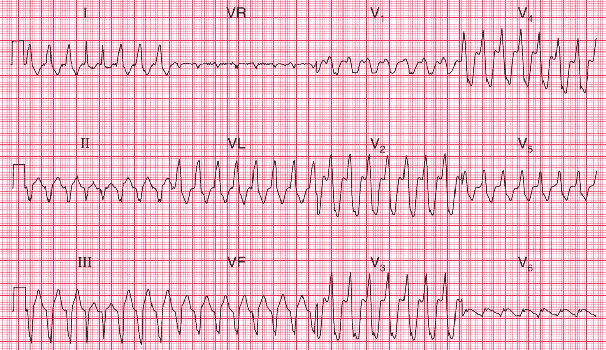 Ventricular tachycardia (VT)