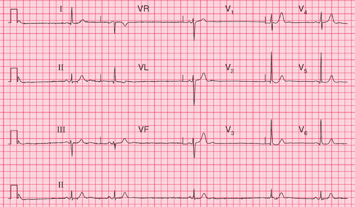 Sick Sinus Syndrome with sinus rhythm and a junctional escape beat
