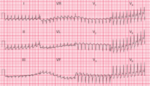 Read more about the article ECG Case 94: Atrioventricular nodal re-entry tachycardia (AVNRT) with ischaemia