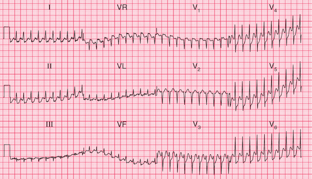 Read more about the article ECG Case 94