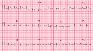 Read more about the article ECG Case 95