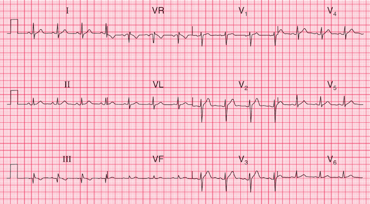 Normal ECG with Q waves and inverted T waves in lead III