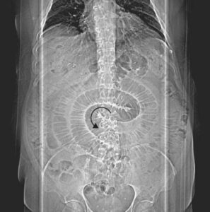 Read more about the article Patient with Abdominal Pain, Nausea, and Bilious Emesis