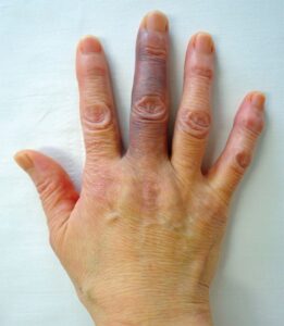 Read more about the article Recurrent Pain and Bruising of Finger